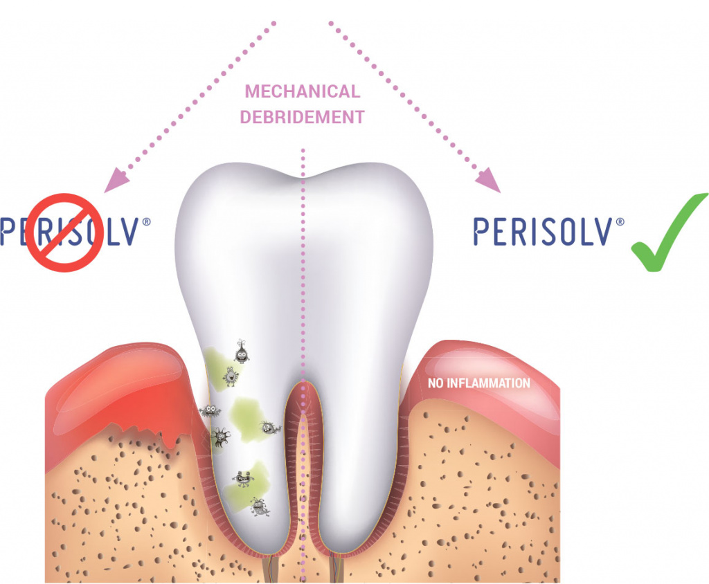 Mechanical debridement with PERISOLV