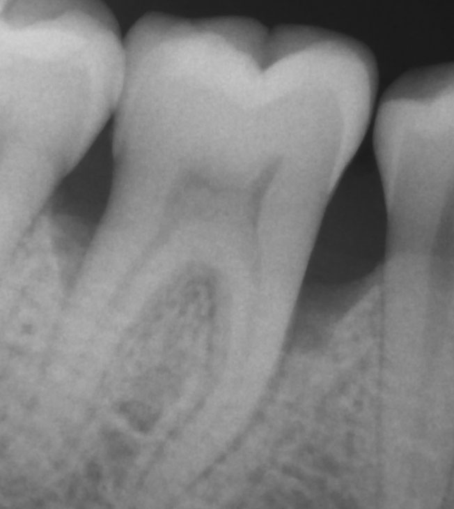 Baseline periapical x-ray