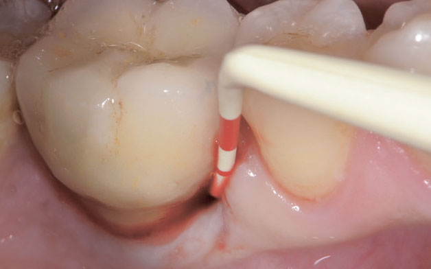 Implant with probing depth (PD) ≤ 5mm and BOP+
