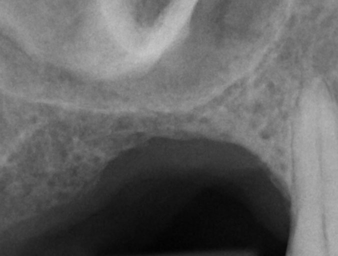History of hopeless maxillary molars