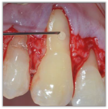 Mandibular Gingival Recession with Furcation Involvement Treated with Cross-linked Hyaluronic Acid